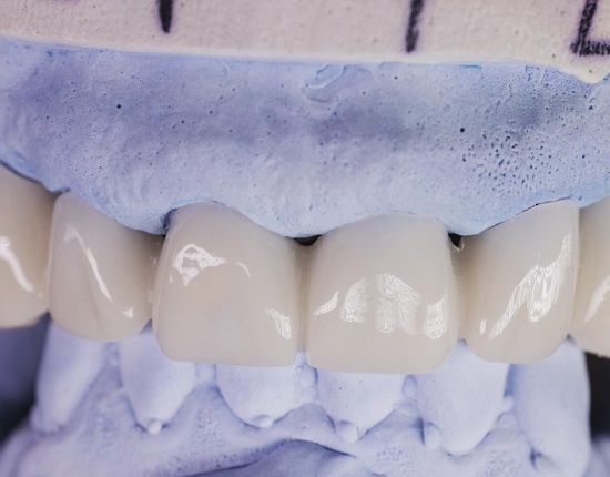 Протезирование зубов металлокерамикой