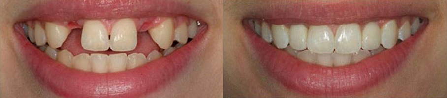 implantaciya-zubov-do-posle.jpg
