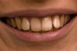 исправление положения зубов